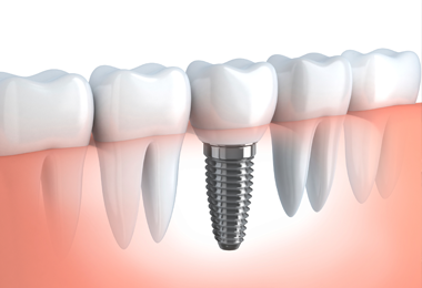 dental implant charlotte