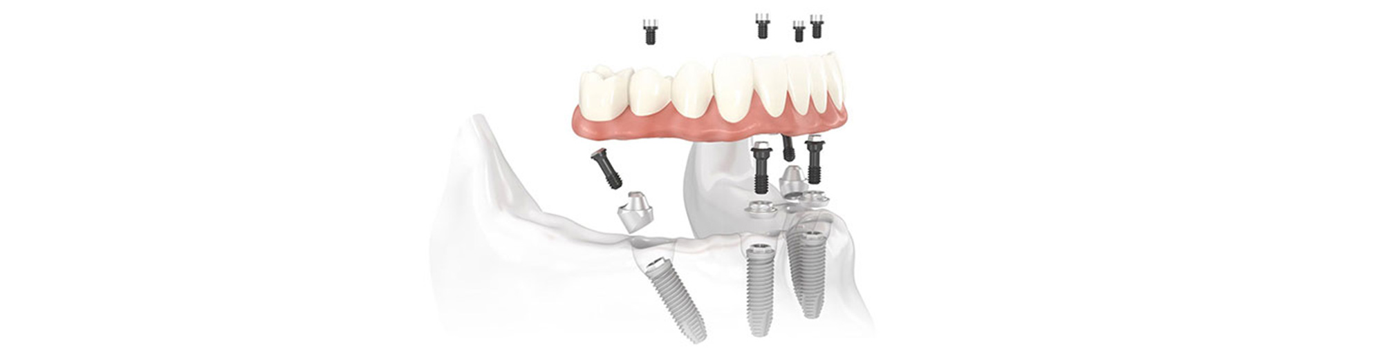 Dental Implants Charlotte